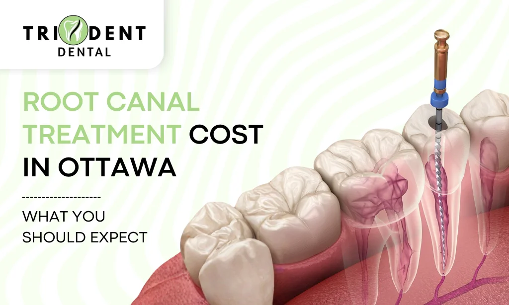 Root Canal Treatment Cost in Ottawa